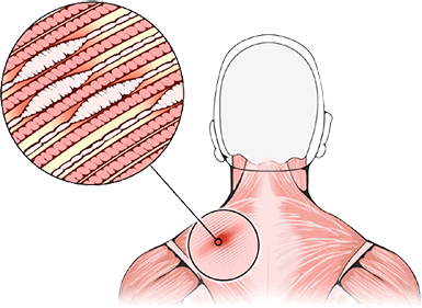 Diagram of a shoulder trigger point with a magnified view showing knotted muscle fibers.